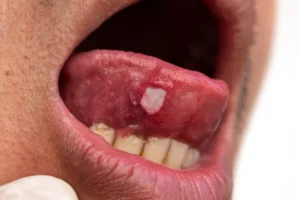 drug induced oral lesions