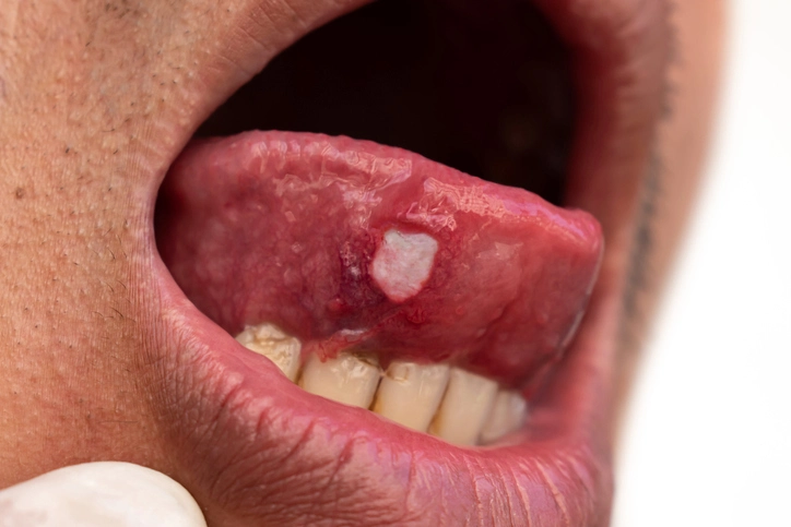 drug induced oral lesions